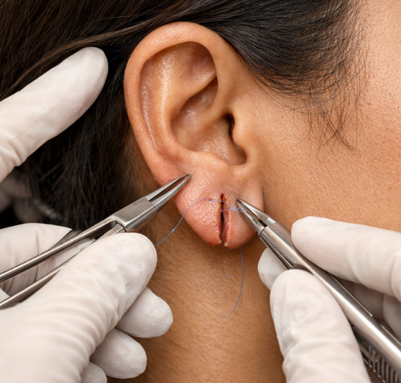 1 Earlobe Repair.png